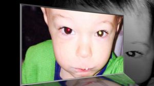 ABCnews Retinoblastoma