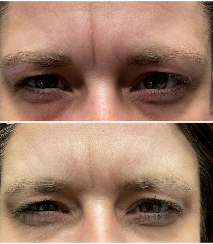 Botox Milwaukee Eye Care