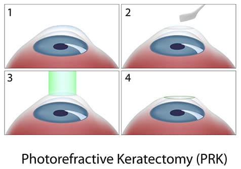 prk eye surgery diagram 