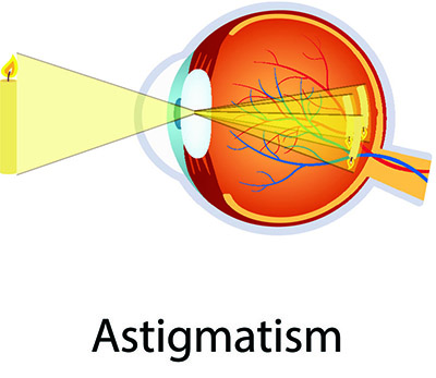 Astigmatism