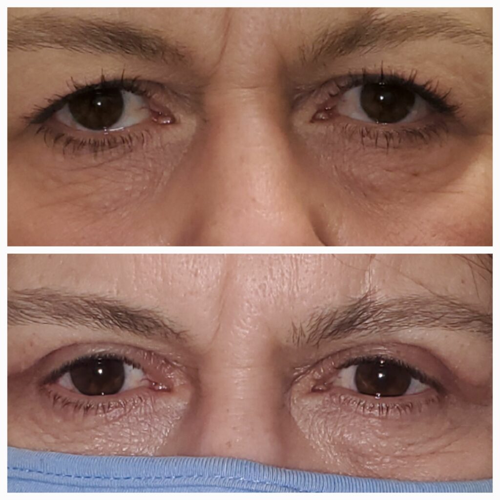 image of woman before eyelid surgery and after eyelid surgery
