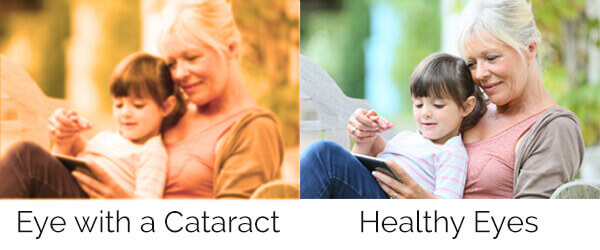 Eye with a cataract vs. Healthy Eyes