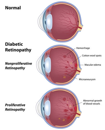 diabeticretinopic