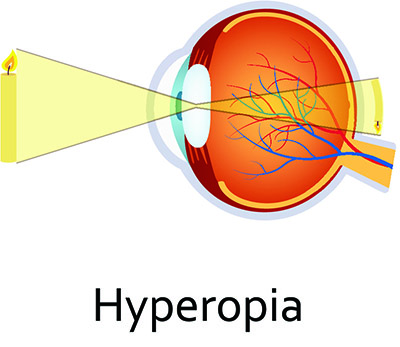 hyperopia