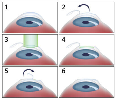 lasik eye surgery diagram