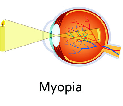 myopia