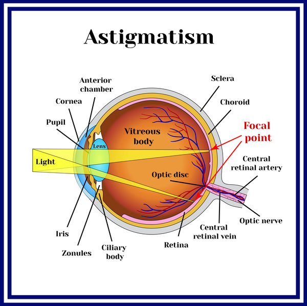 Astigmatism