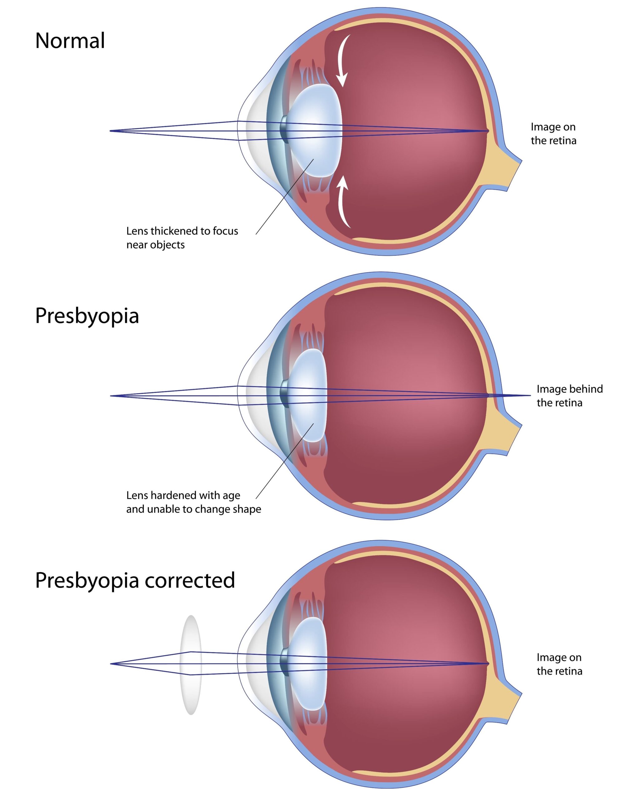 Premium Lens Implants Franklin  Specialty Intraocular Lenses